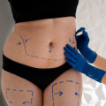 Understanding Liposuction: A Comprehensive Guide to Medical Weight Loss