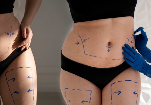 Understanding Liposuction: A Comprehensive Guide to Medical Weight Loss